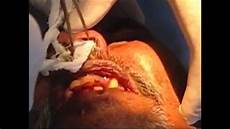 Gauze Dressing